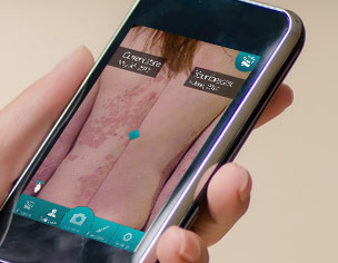 Psoriasis APP